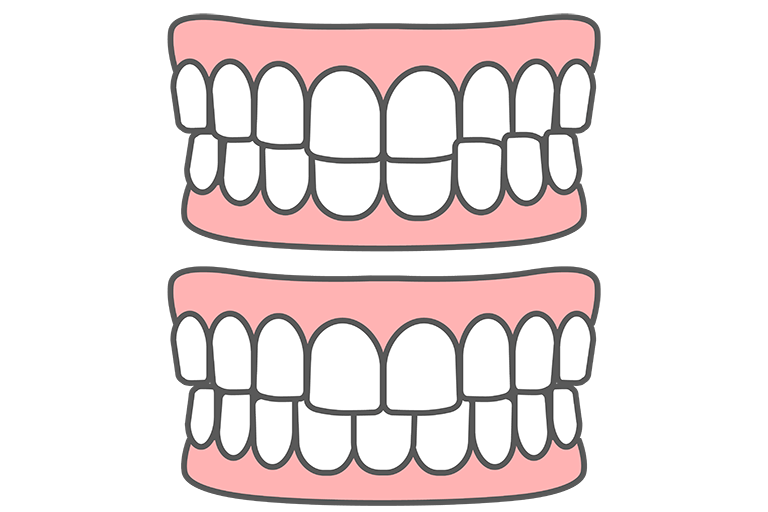歯がすれ違っているのが気になる(交叉咬合)
