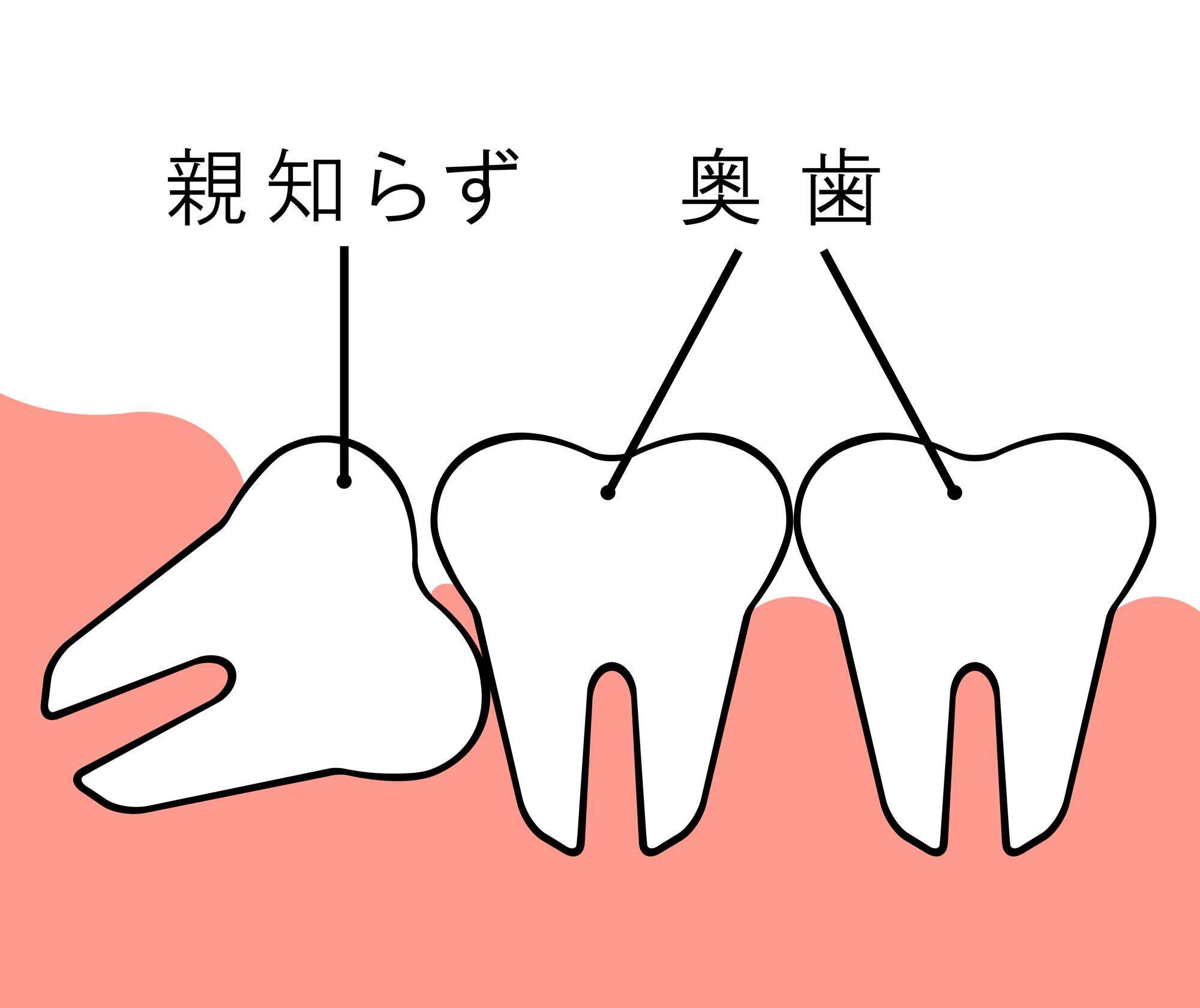 そもそも親知らずとは？