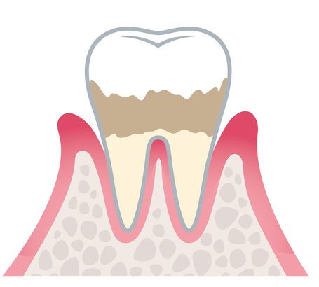 軽度歯周炎