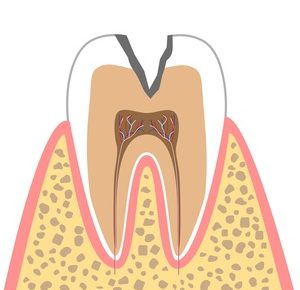 C2:象牙質のむし歯